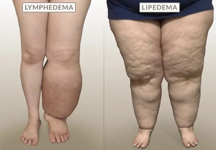 Lipedema vs Lymphedema