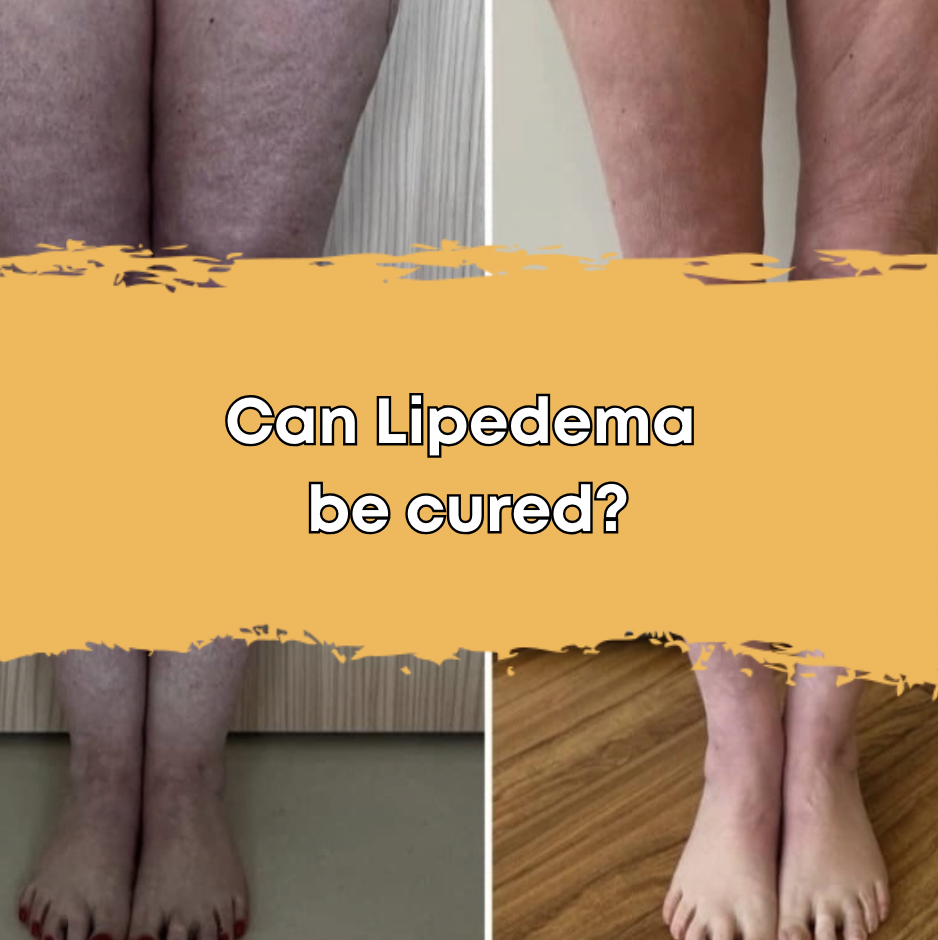 Can Lipedema be cured?