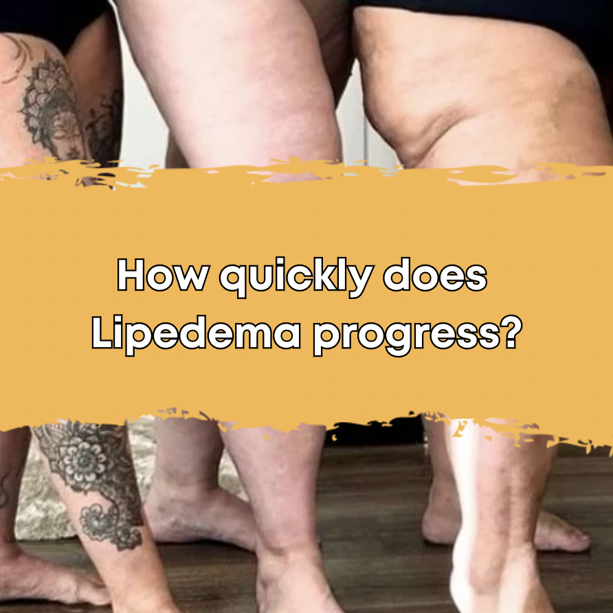 How quickly does Lipedema progress?