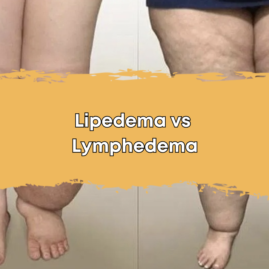 Lipedema vs Lymphedema
