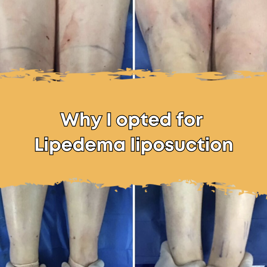 Why I opted for Lipedema liposuction