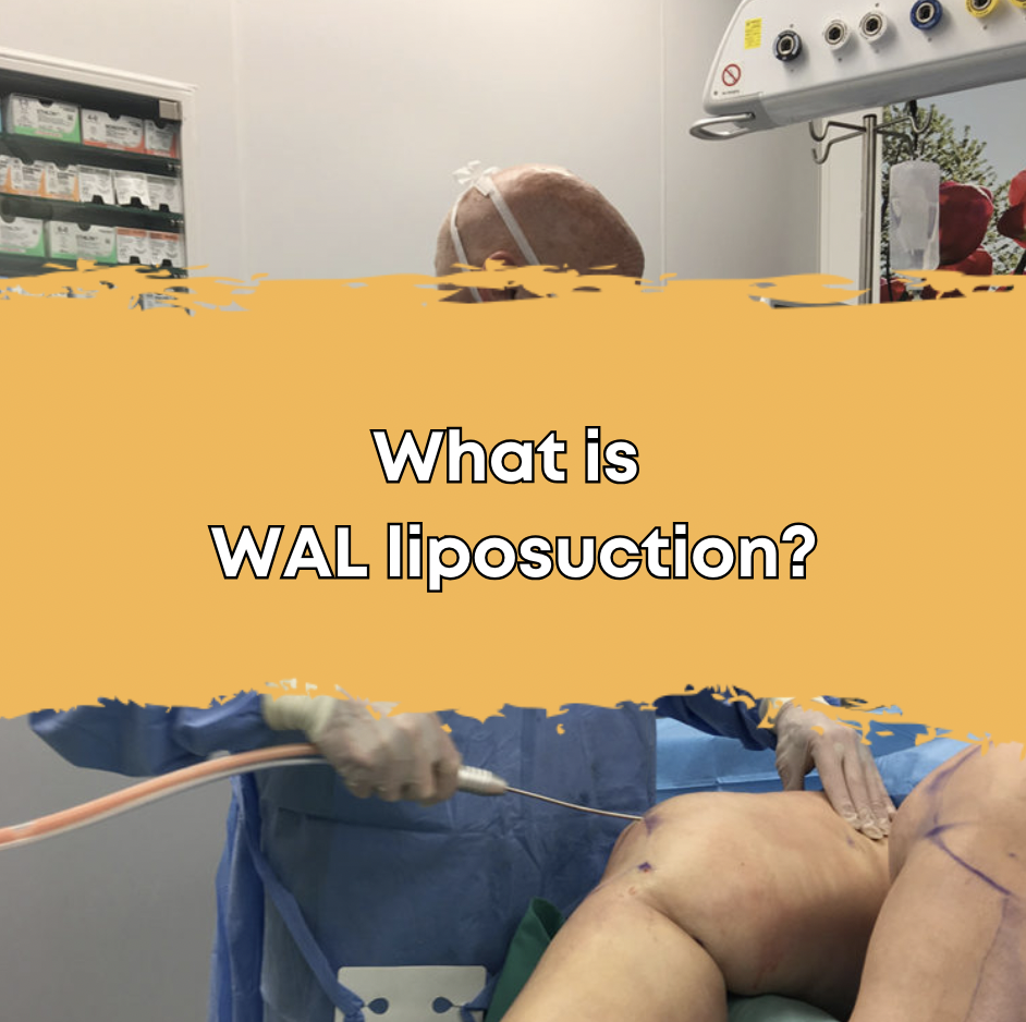 What is WAL liposuction?