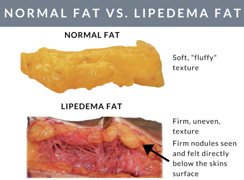 Normal fat vs Lipedema fat