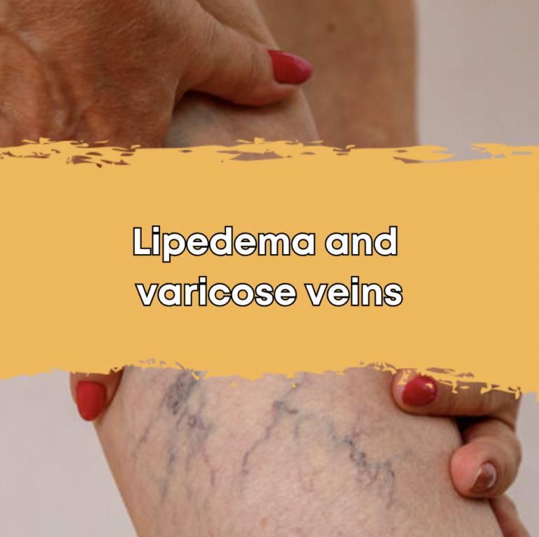 Lipedema and varicose veins