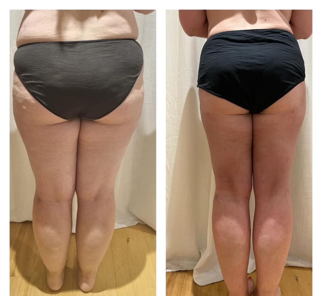 Stage 3 Lipedema Before and After - Back View