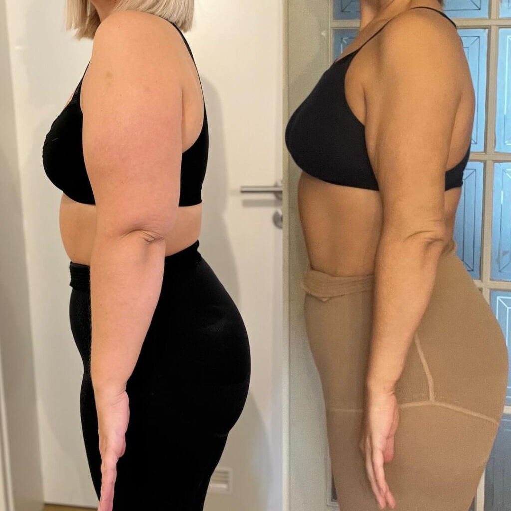 Lipedema Stage 3 Arms Before and After - Side View