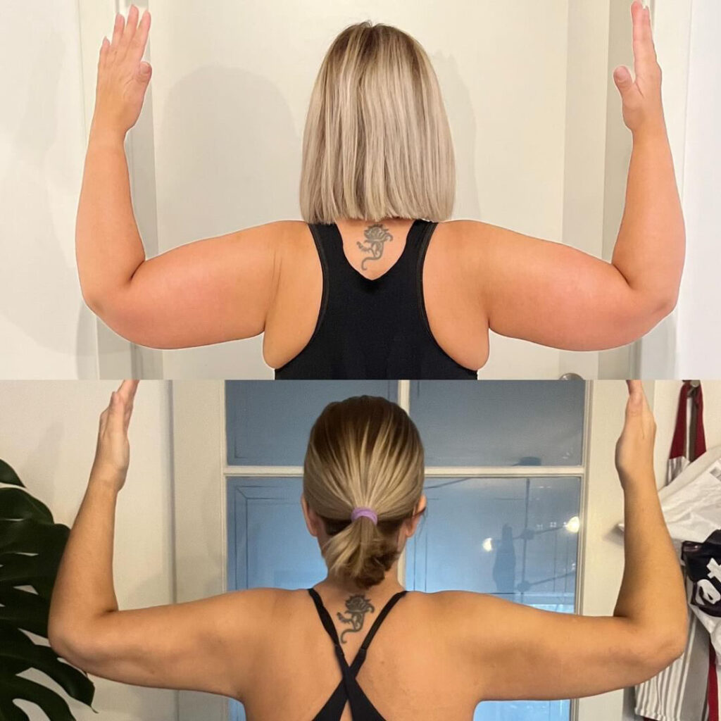 Lipedema Stage 3 Arms - Before and After