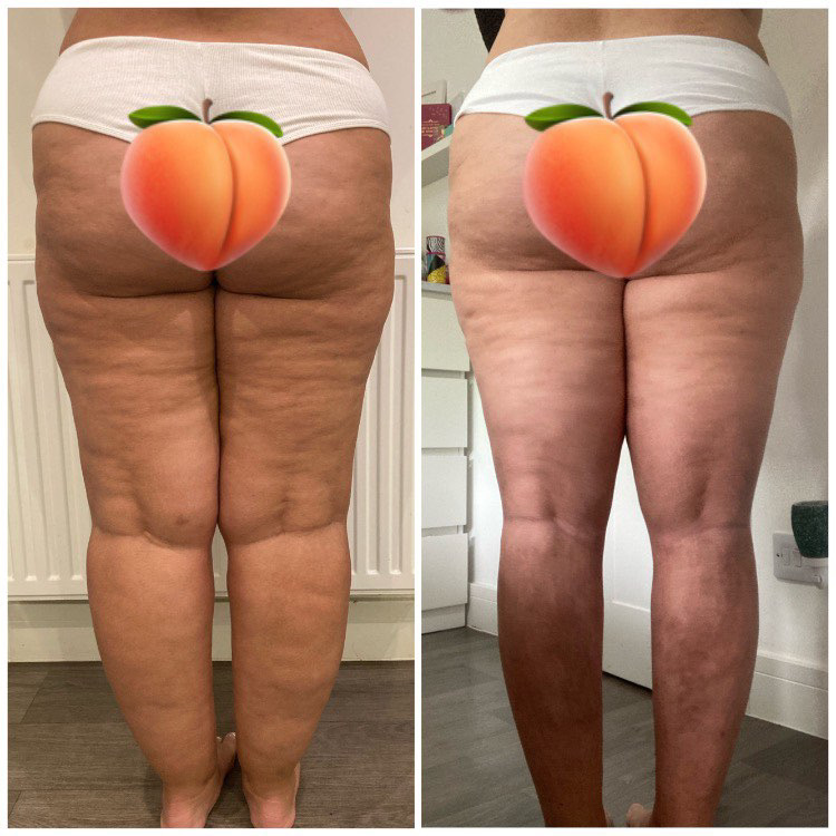 Lipedema Stage 3 Before and After Lowers - Back View