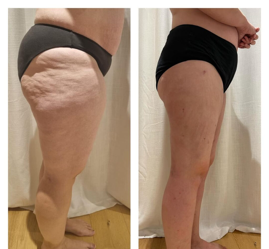 Lipedema Stage 3 Side View Before and After