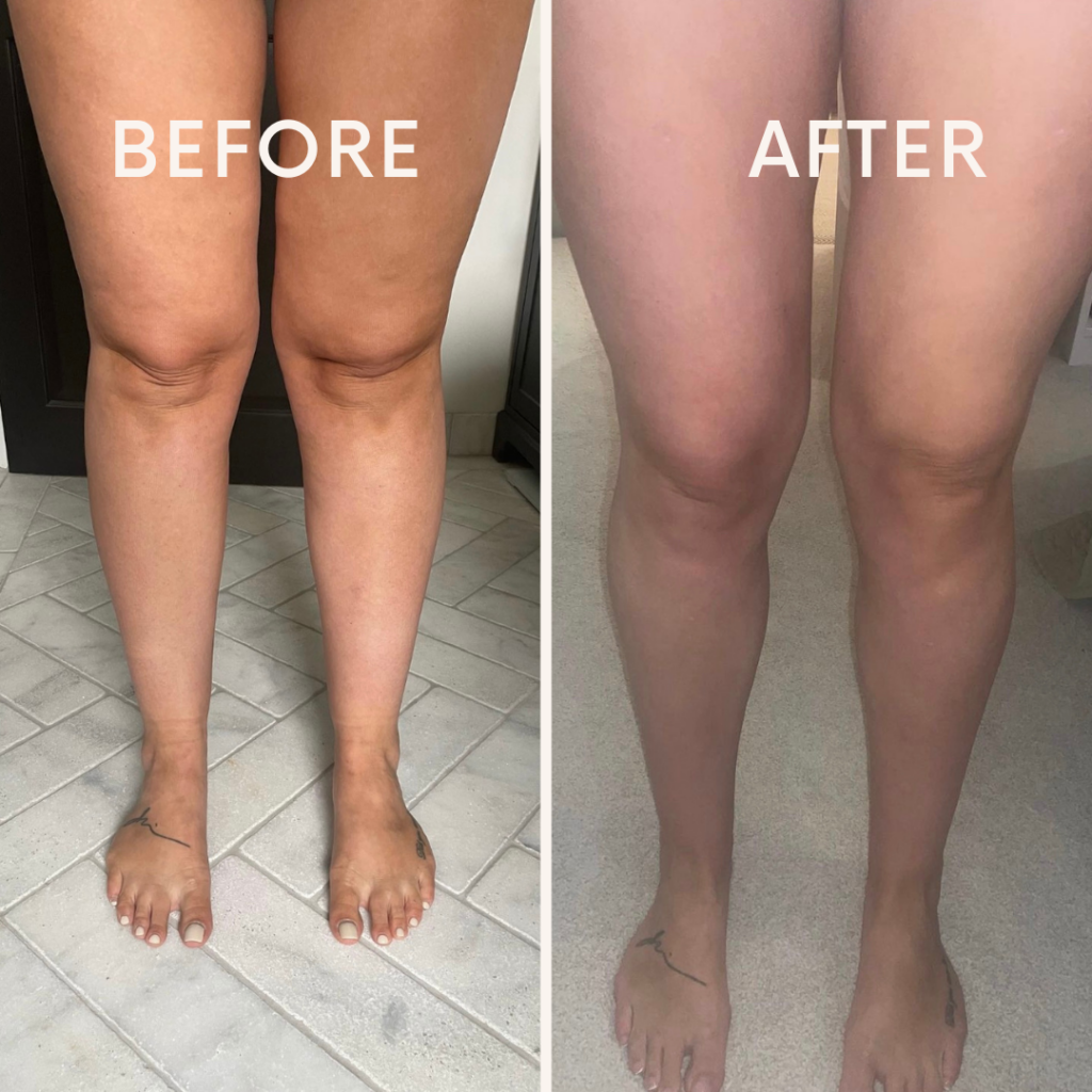 Before and After Lipedema Stage 2 Lipemedical