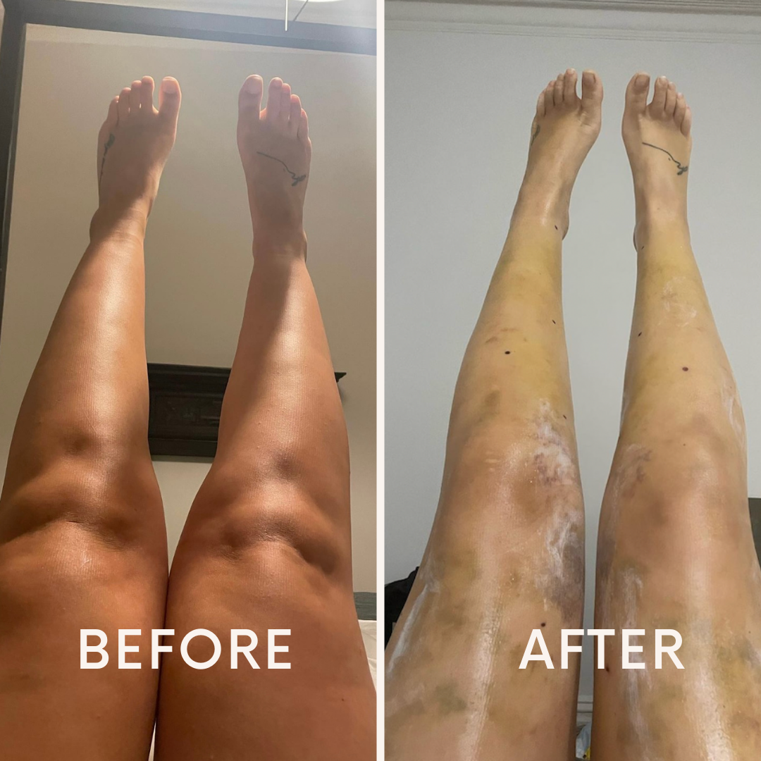 Lipedema Knees Before And After Lipedema And Me