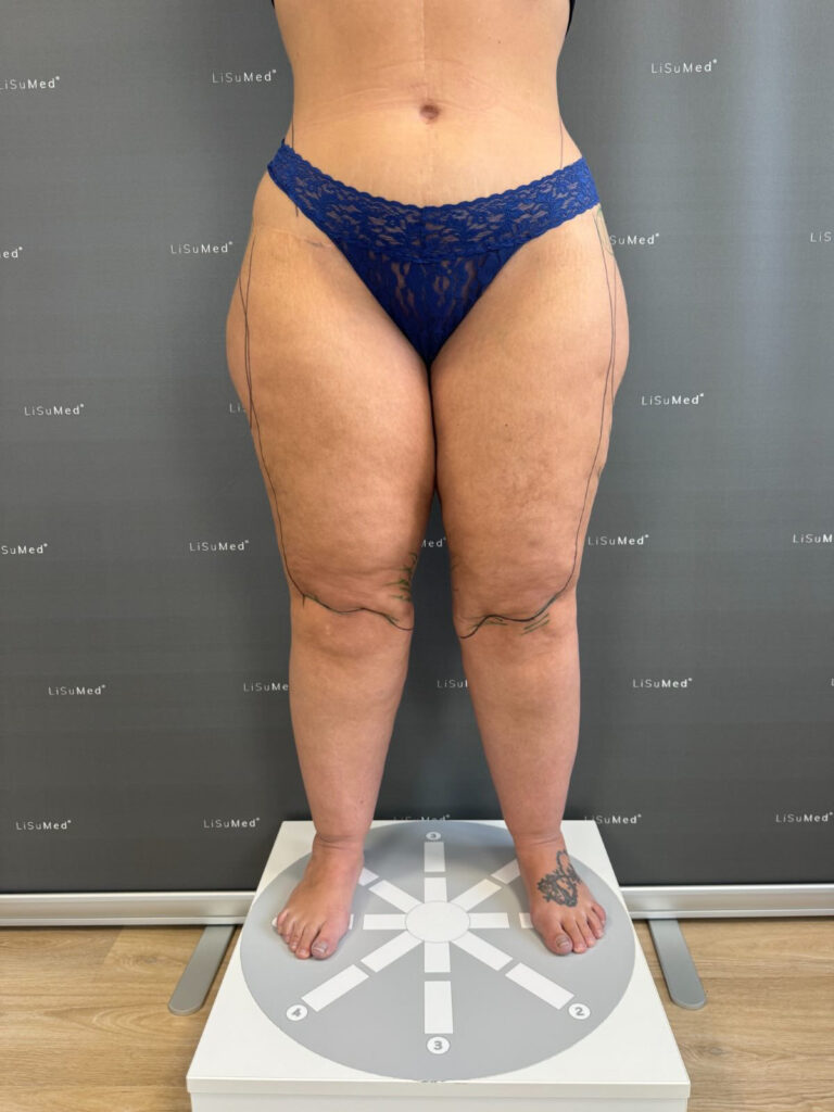 Stage 3 Lipedema - Front View
