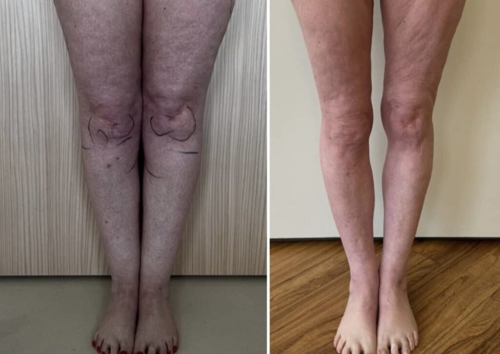 Lipedema Stage 2 Before and After Surgery Front View