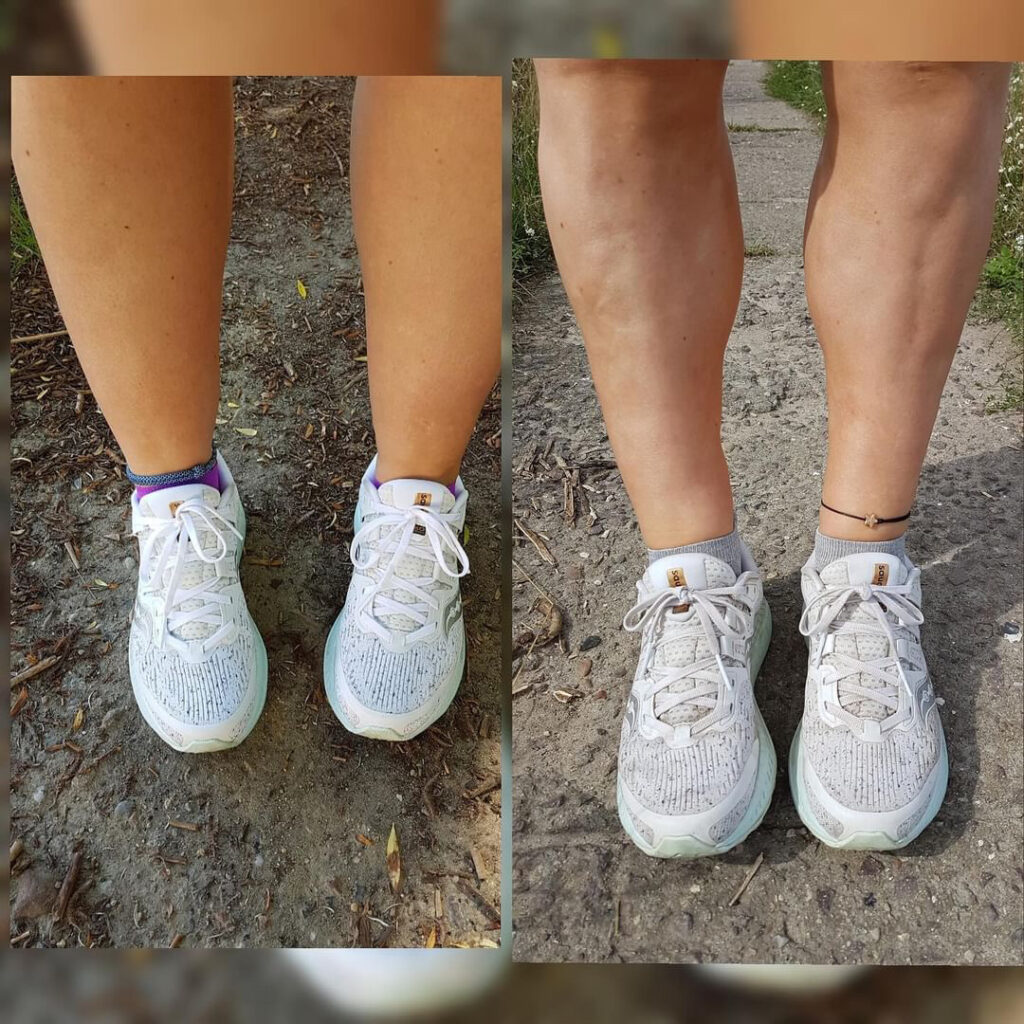 Lipedema Stage 2 Before and After Surgery Lower Legs