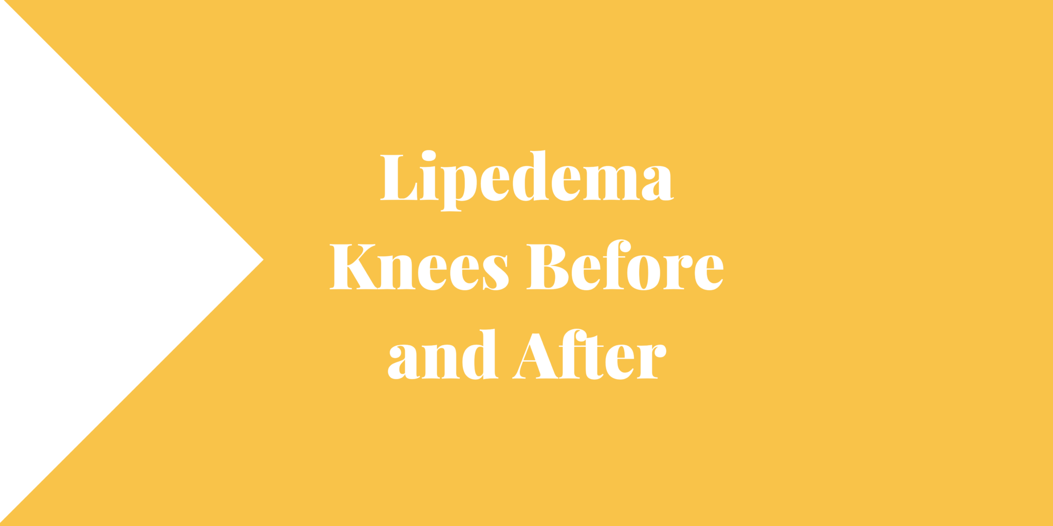 Lipedema Knees Before and After Lipedema and Me