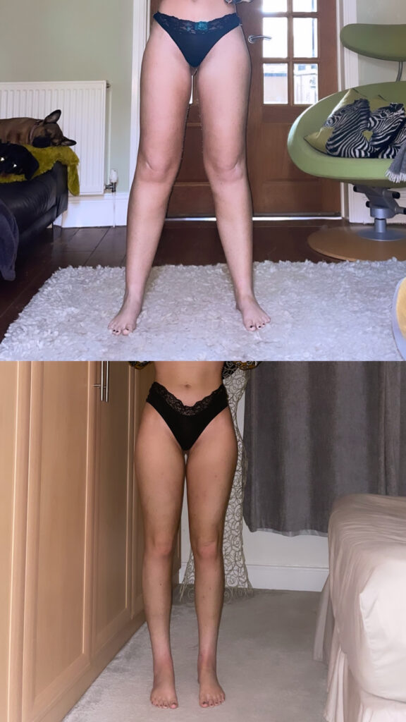 Lipedema Knees Before and After Surgery