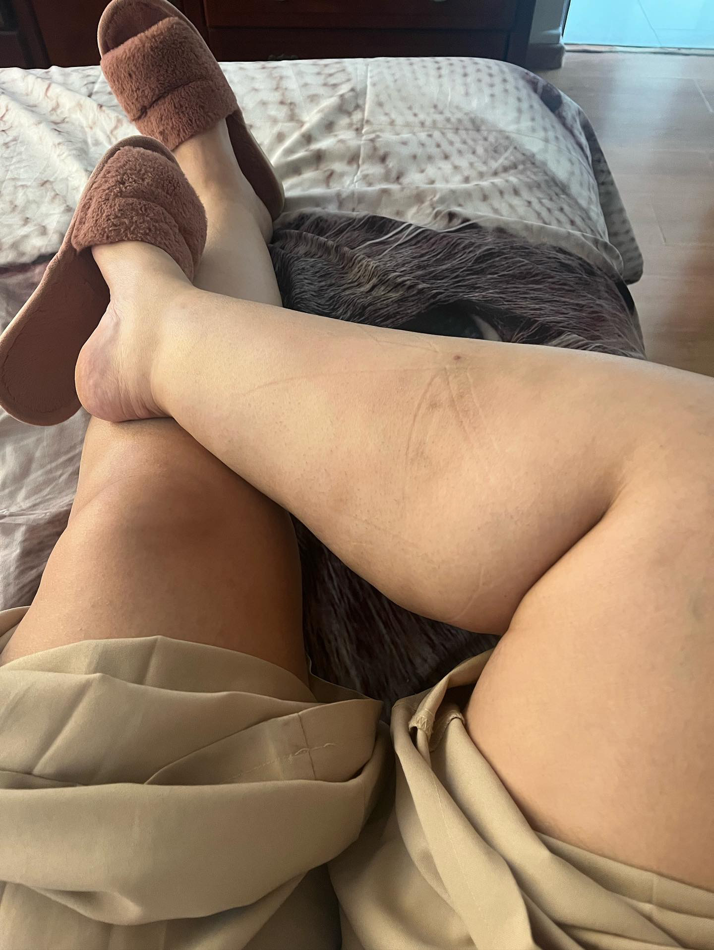 Lipedema Stage 2 Lower Legs