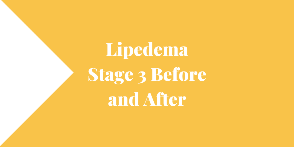 Lipedema Stage 3 Before and After