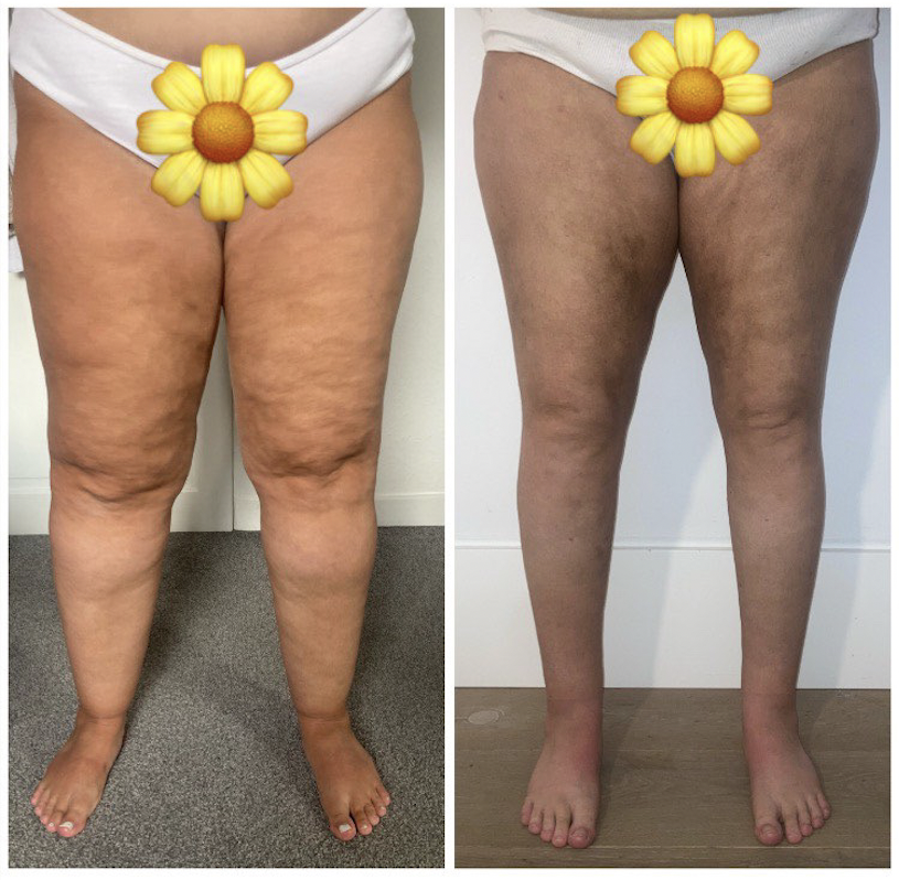 Before and After - Stage 3 Lipedema Lowers