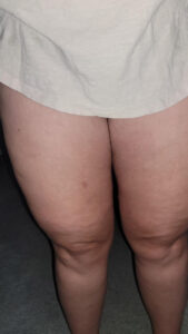 Lipedema Stage 2 Knees and Thighs