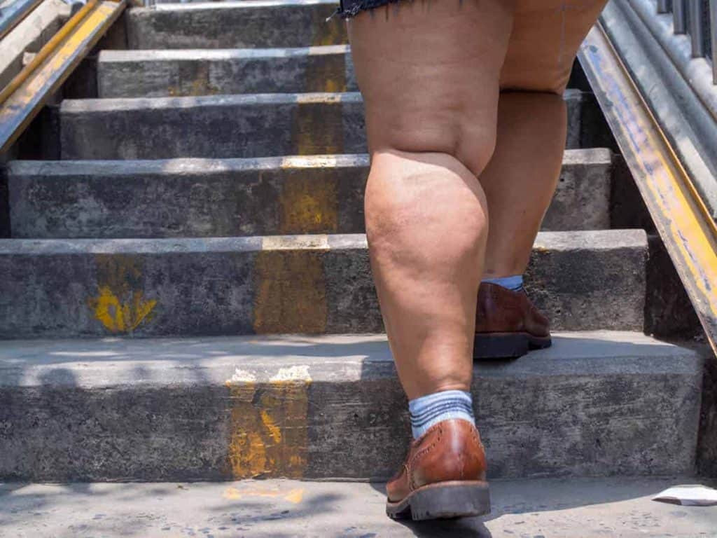 Does Exercise Help Lipedema?