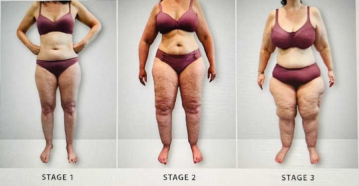 Lipedema Progression