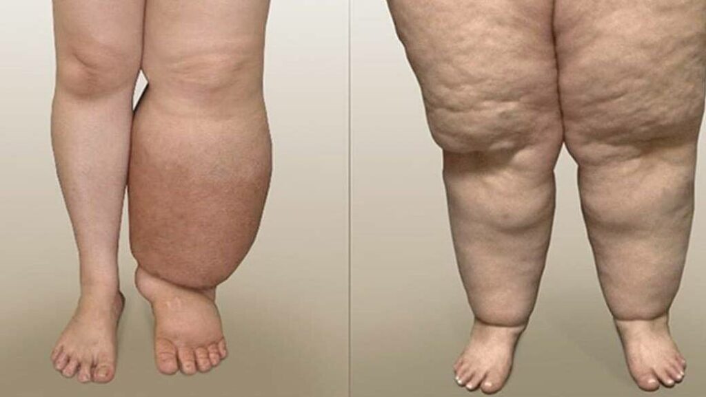 Learn if Fat Legs Are Considered Lipedema