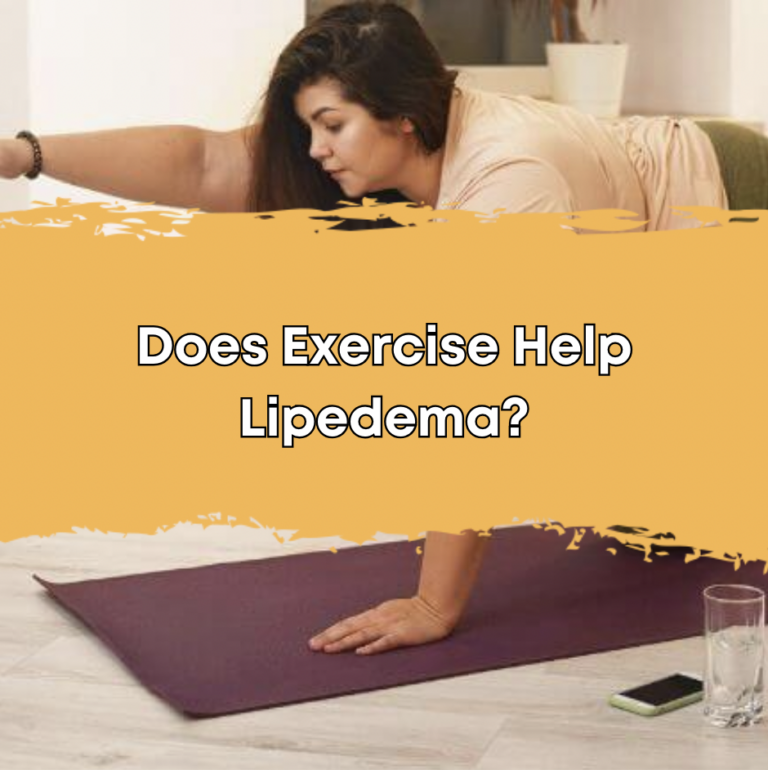 Does Exercise Help Lipedema?