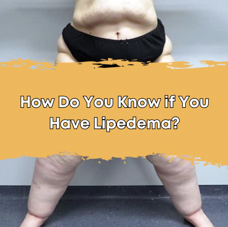 How Do You Know if You Have Lipedema?