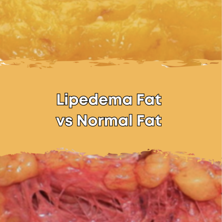 Lipedema Fat vs Normal Fat