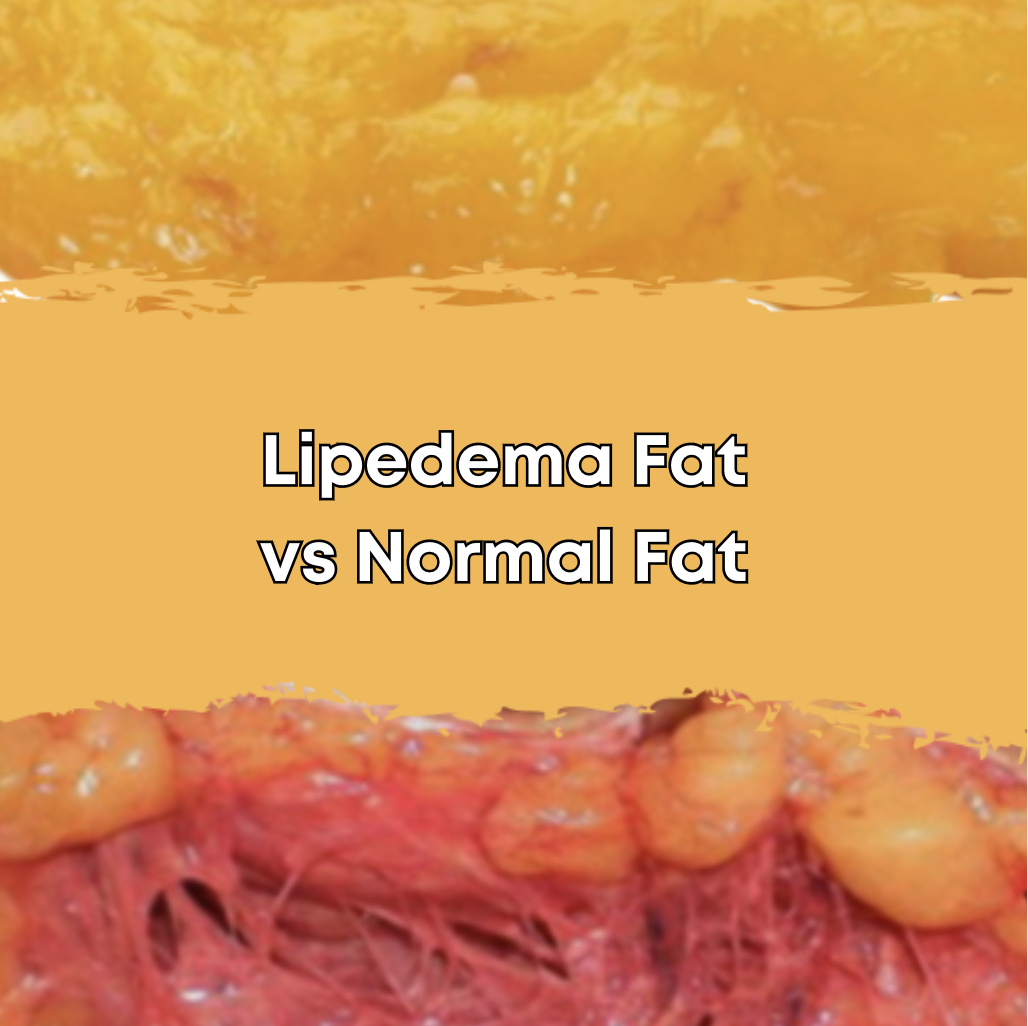 Lipedema Fat vs Normal Fat