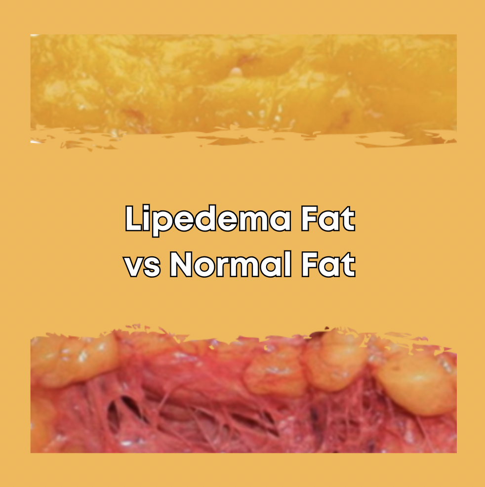 Lipedema Fat vs Normal Fat