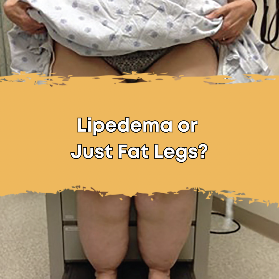 Lipedema or Just Fat Legs?