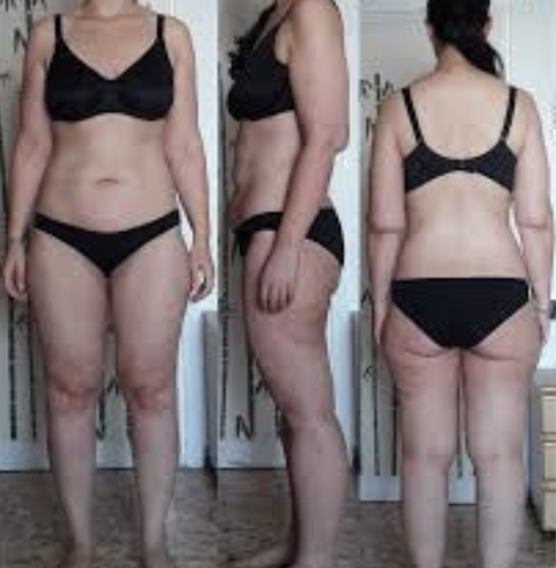 Lipedema and keto diet after