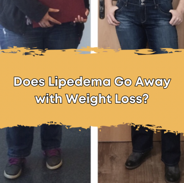 Does Lipedema Go Away with Weight Loss?
