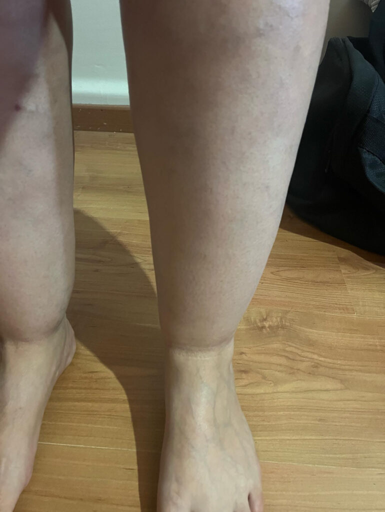 Lipedema Stage 2 Ankle Cuff