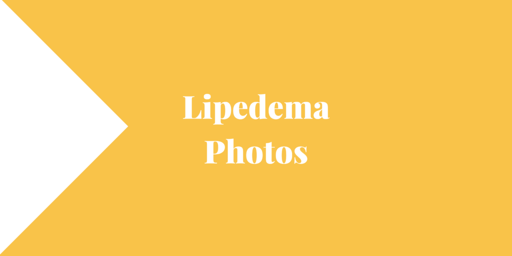 Lipedema Photos