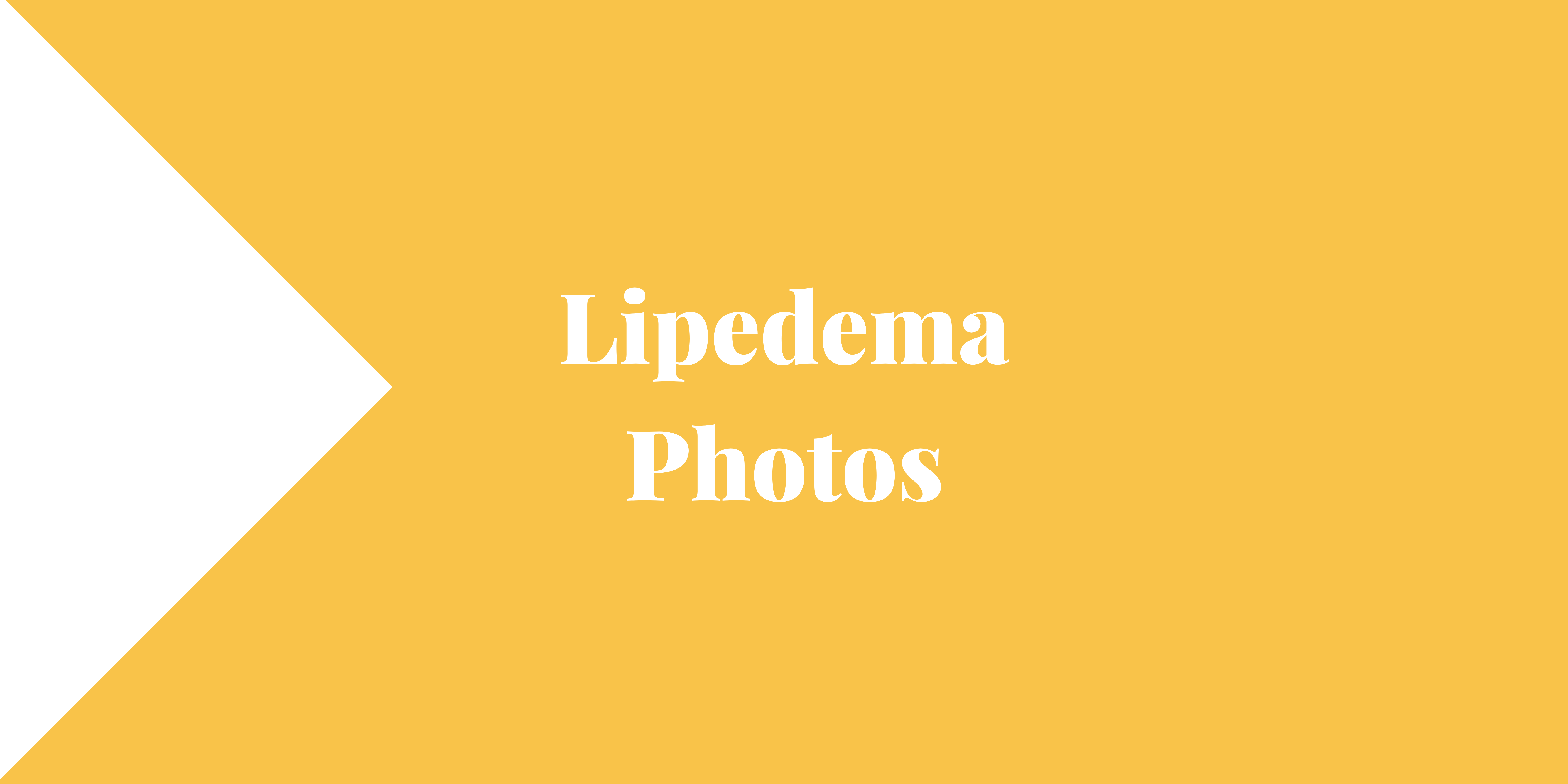 Lipedema Photos - Lipedema and Me