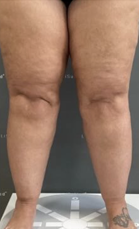 Lipedema Stage 3 Legs