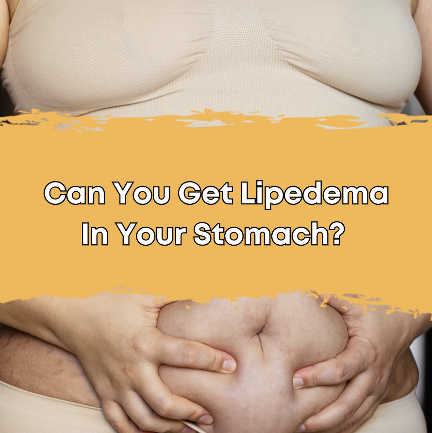 Can You Get Lipedema In Your Stomach?