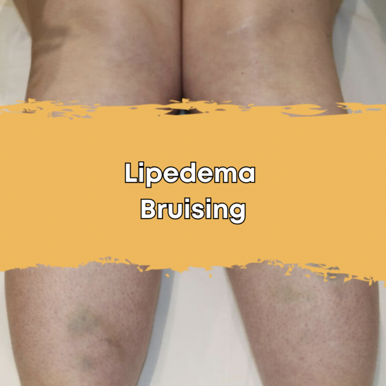 Lipedema Bruising