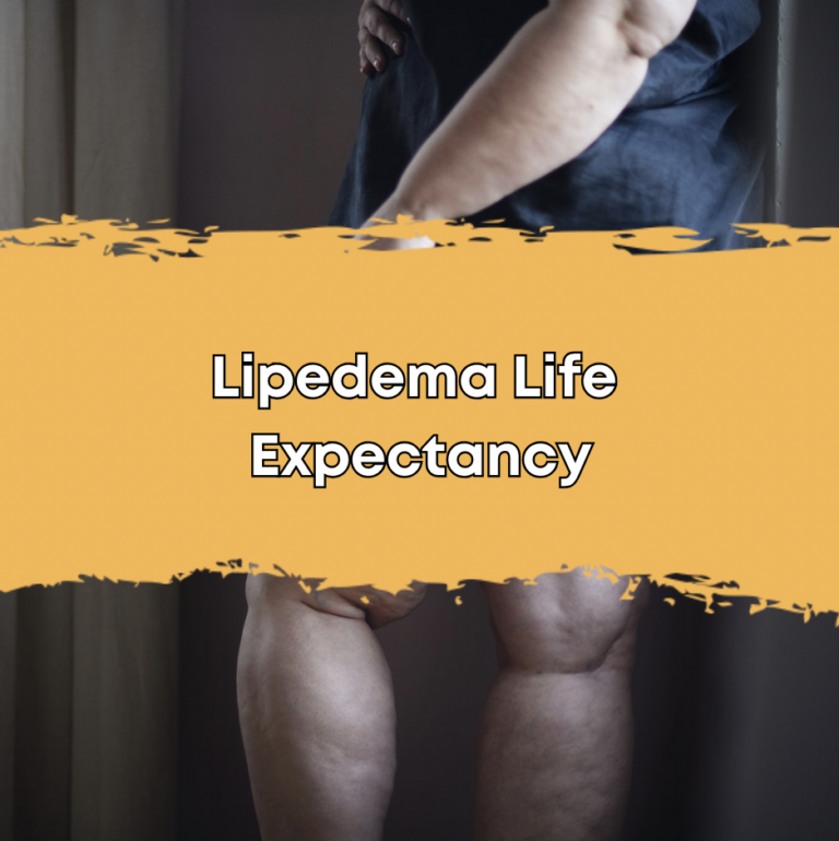Lipedema Life Expectancy