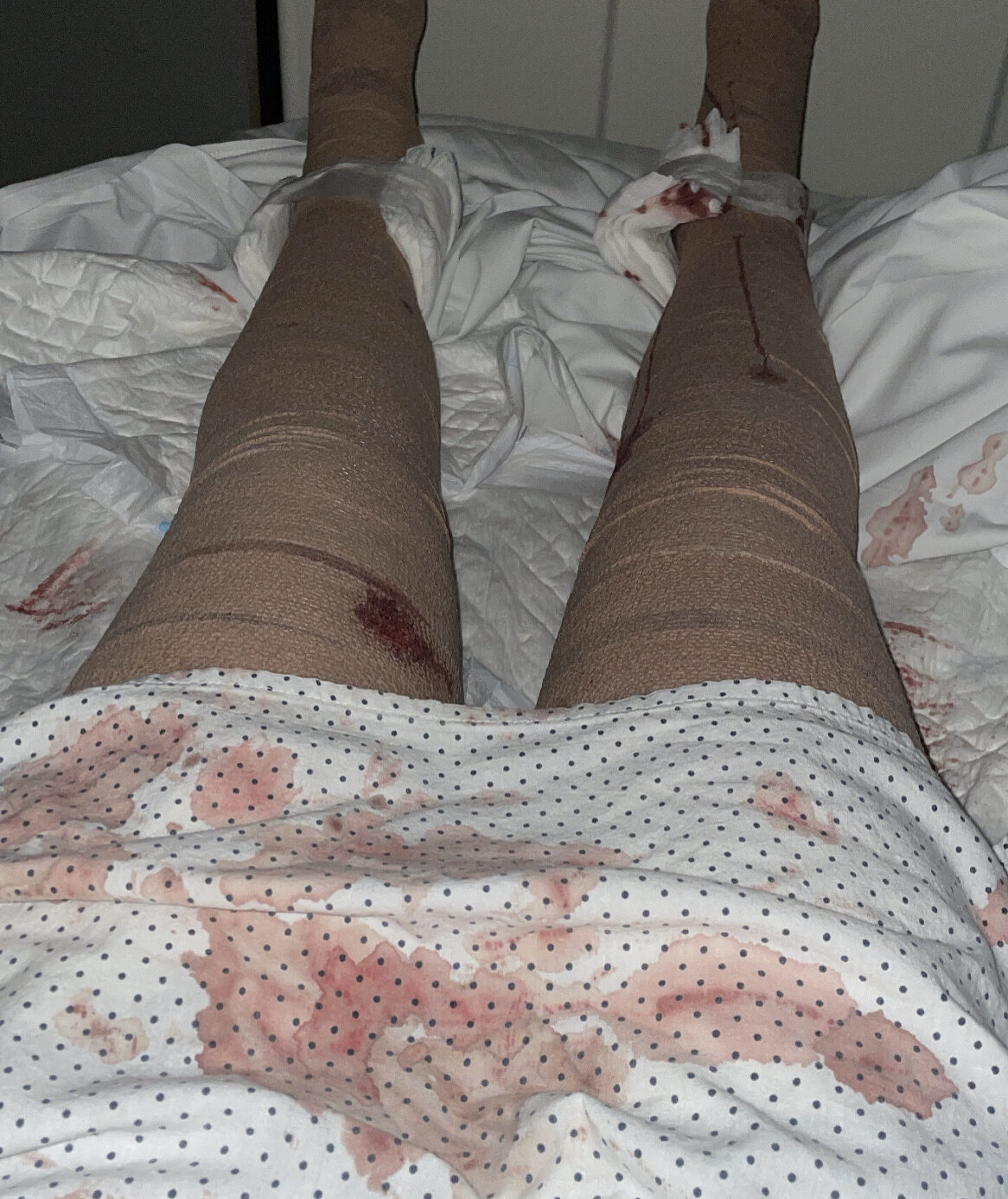 Lipedema Reduction Surgery With Lipemedical My Honest Experience