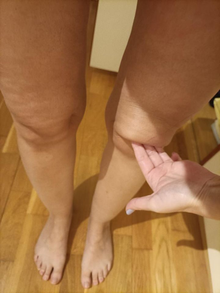 Stage 1 Lipedema