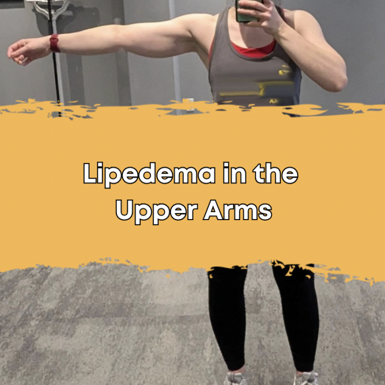 Lipedema in the Upper Arms