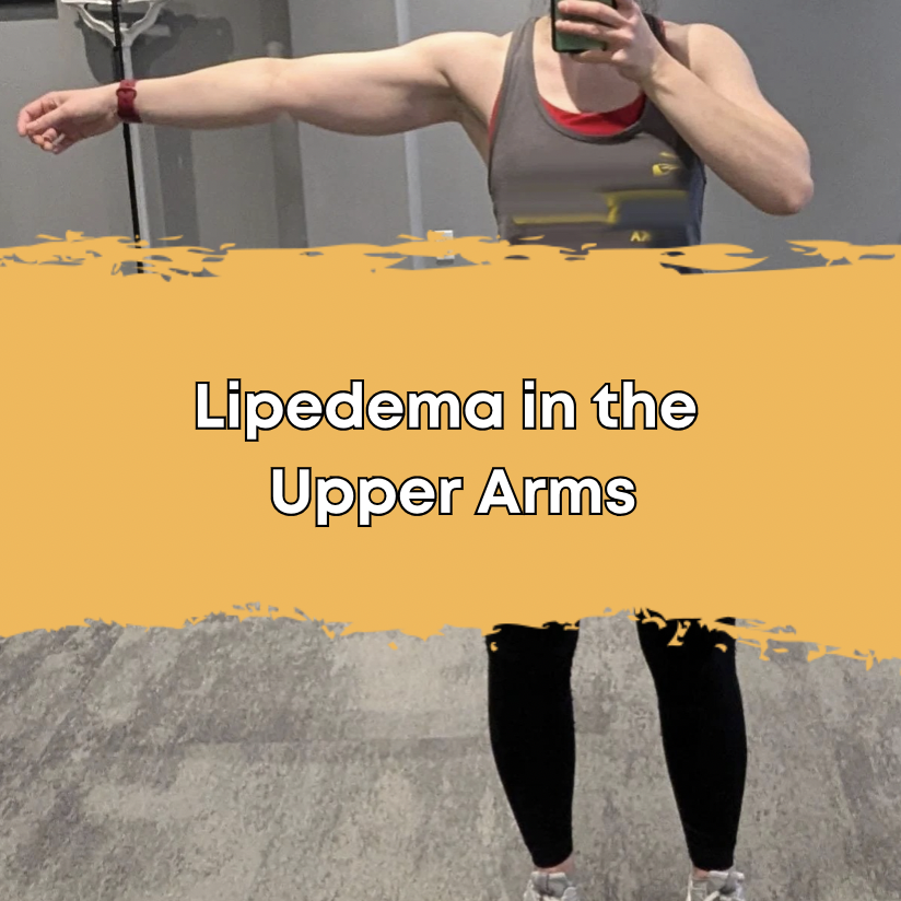 Lipedema in the Upper Arms