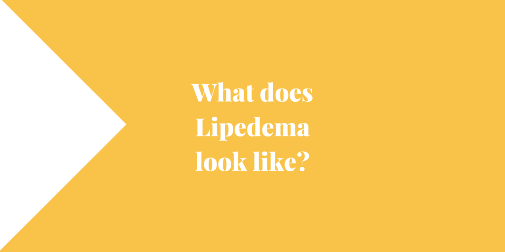 What does Lipedema look like?
