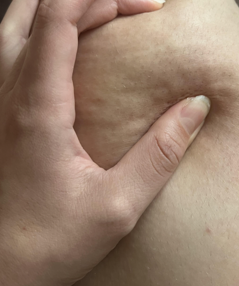 Lipedema Pinch Test