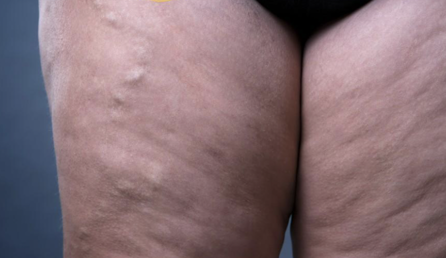 Lipedema and Venous Insufficiency