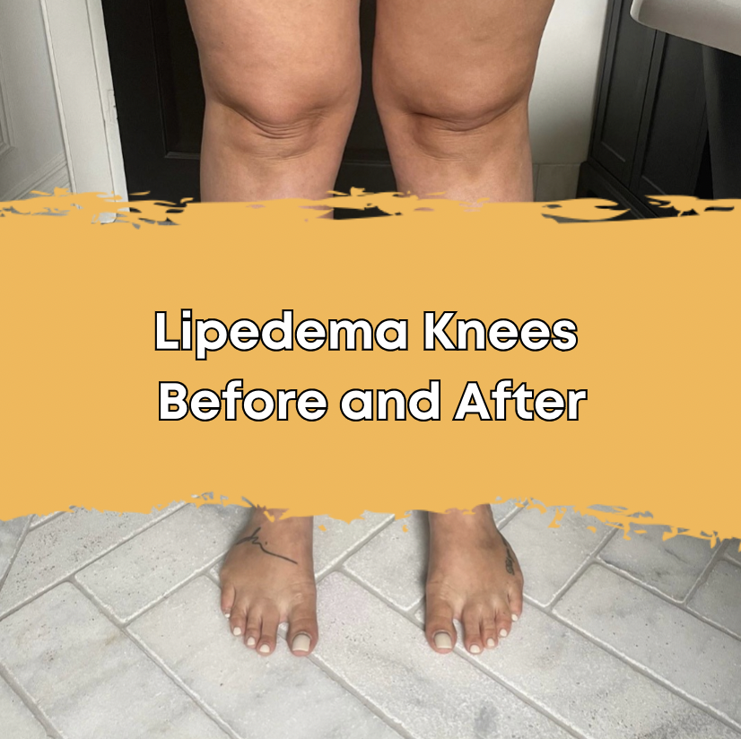 Lipedema Knees Before and After